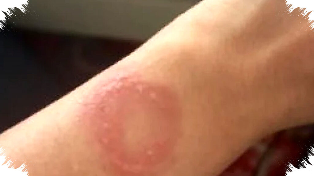 Apple Watch Panas Mendadak Luka Bakar Parah, Pengguna Terperangkap Labirin Apple Support Tak Berujung